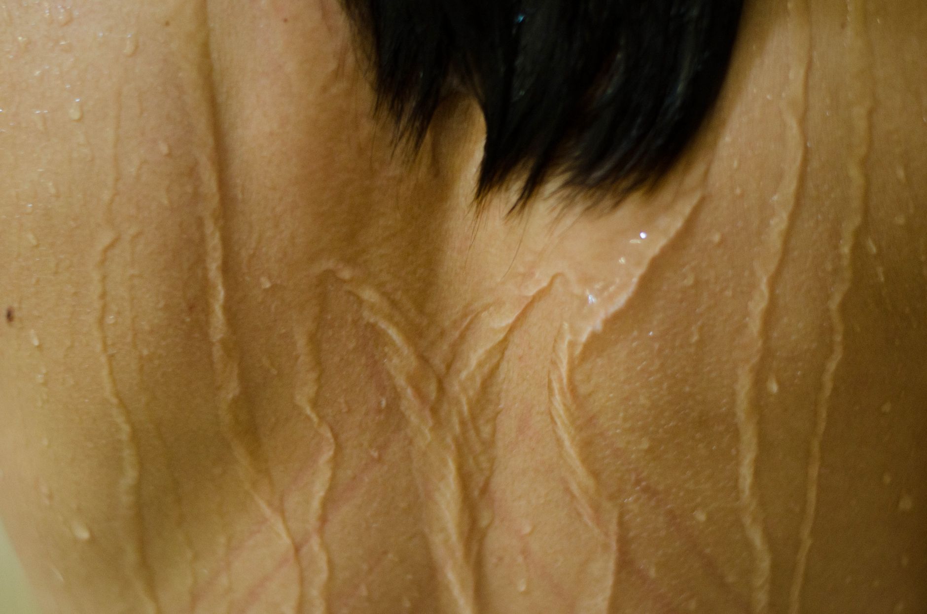 Why honest clinics say 'hair reduction', not 'hair removal'