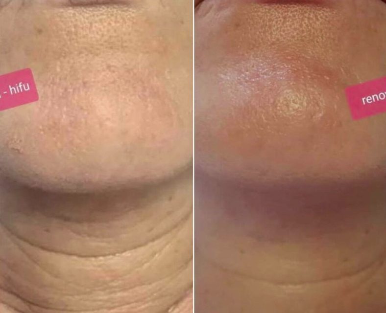 HIFU neck treatment before and after