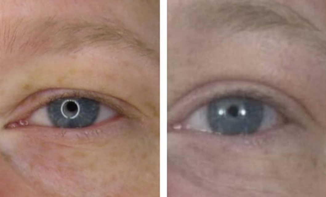 Under-eye treatment before and after