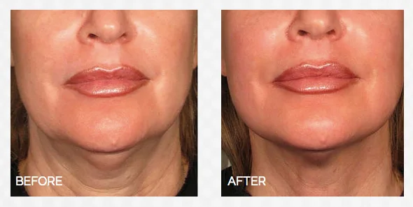 HIFU before and after, lower face and jawline