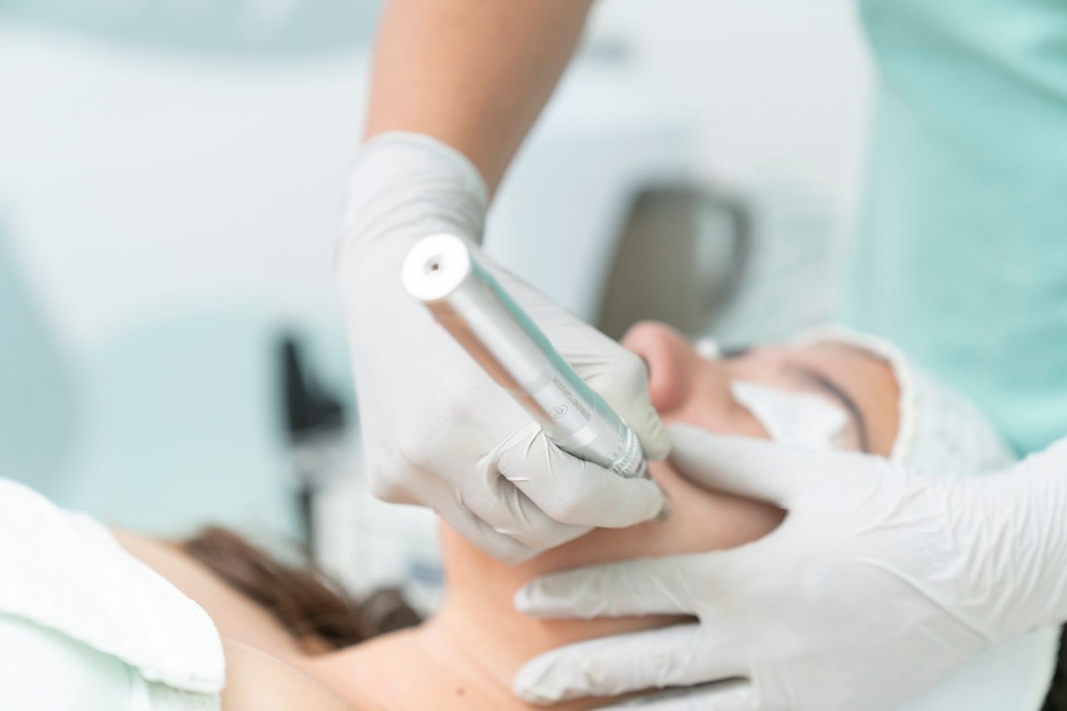 Laser skin clarity treatment