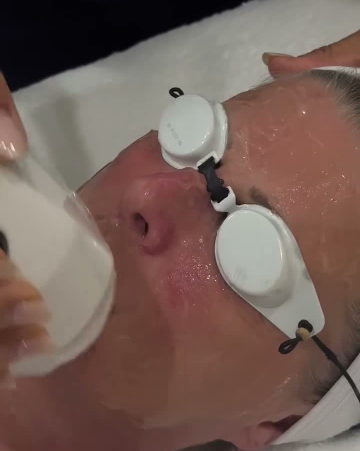 Laser Resurfacing