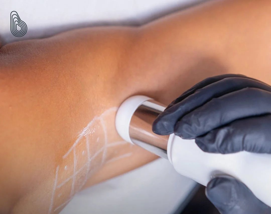 Underarm Sweat Reduction at Skin Body Health